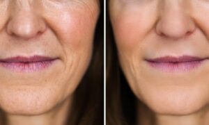 que faire pour enlever supprimer attenuer réduire rides autour des lèvres bouche rides du sourire sans chirurgie femme peau mature traitement naturel