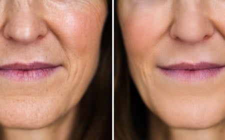 que faire pour enlever supprimer attenuer réduire rides autour des lèvres bouche rides du sourire sans chirurgie femme peau mature traitement naturel