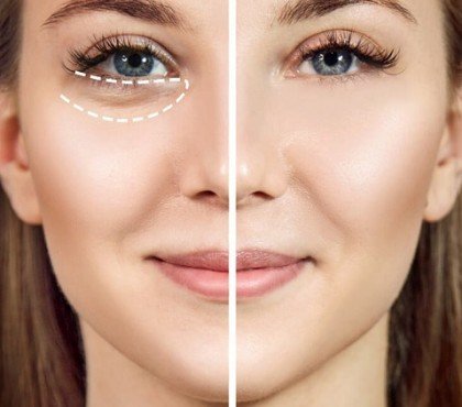 anti poches sous les yeux efficace chirurgie ou remèdes maison