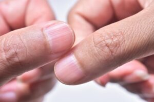 causes stries sur les ongles comment soigner traiter que faire
