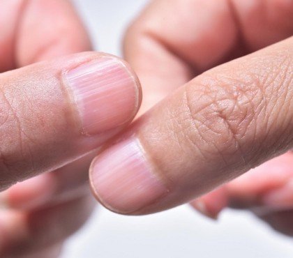 causes stries sur les ongles comment soigner traiter que faire