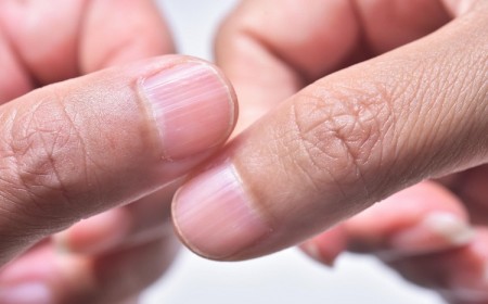 causes stries sur les ongles comment soigner traiter que faire