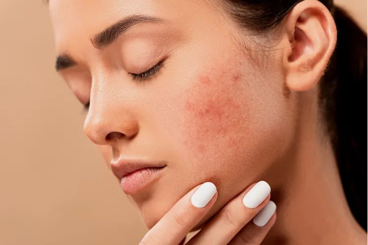 Comment diminuer la pigmentation de la peau : conseils et méthodes efficaces