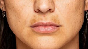 melasma mustache comment enlever l'hyperpigmentation de la moustache