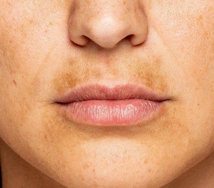 melasma mustache comment enlever l'hyperpigmentation de la moustache