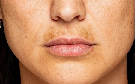 melasma mustache comment enlever l'hyperpigmentation de la moustache