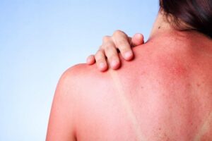 comment faire dérougir coup de soleil traiter peau brulée quels bons gestes adopter