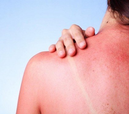 comment faire dérougir coup de soleil traiter peau brulée quels bons gestes adopter