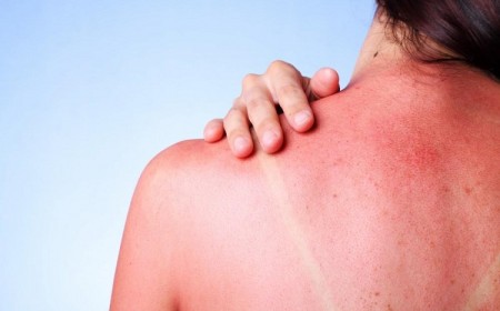 comment faire dérougir coup de soleil traiter peau brulée quels bons gestes adopter