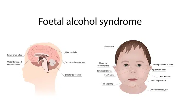 syndrome alcoolisme fœtal