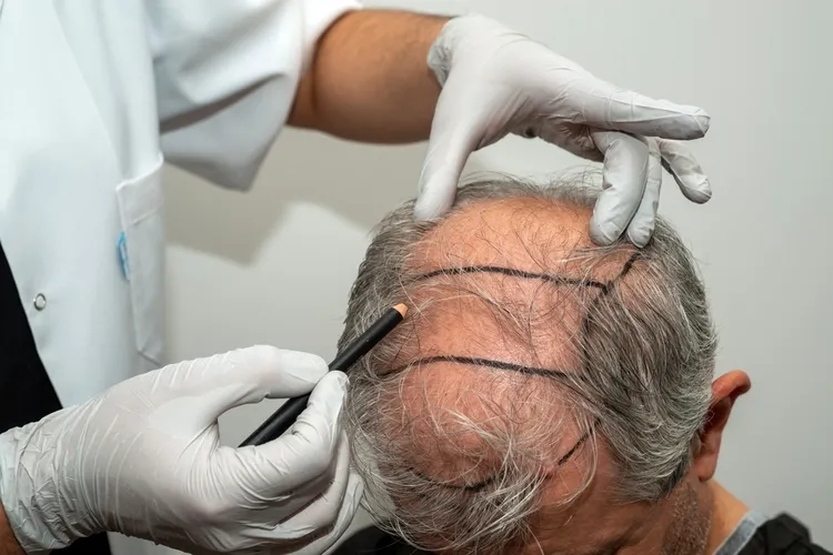 chirurgie esthétique, greffe cheveux turquie