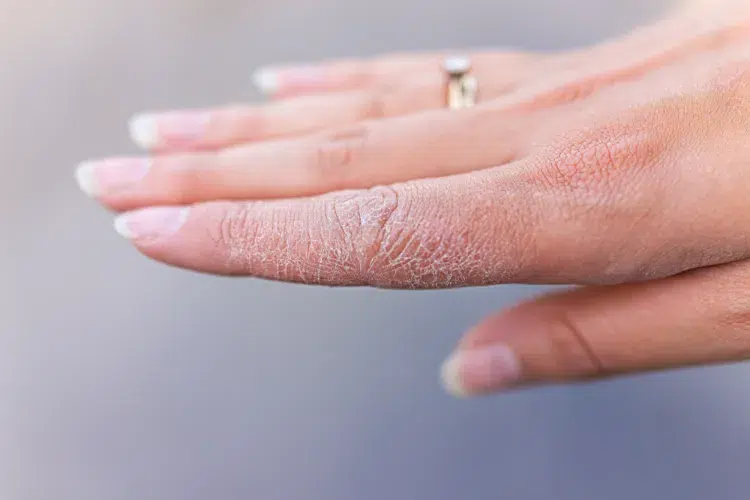 les carences nutritionnelles affectent la santé de la peau et des ongles