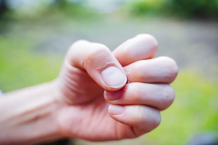 pourquoi la peau autour des ongles est sèche et comment soigner les cuticules