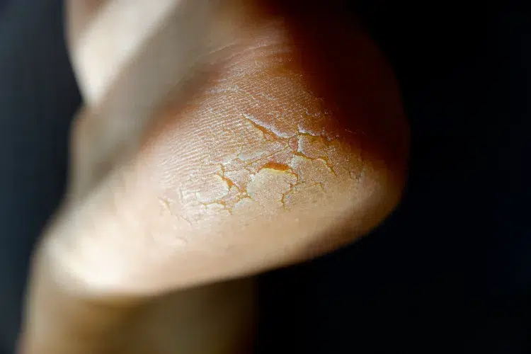 Soins des pieds pour éviter les crevasses et sécheresses,Soins pieds éviter crevasses sécheresses