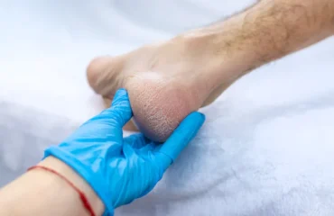 Soins des pieds pour éviter les crevasses et sécheresses,Soins pieds éviter crevasses sécheresses