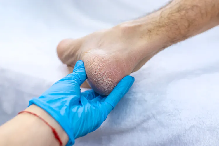 Soins des pieds pour éviter les crevasses et sécheresses,Soins pieds éviter crevasses sécheresses