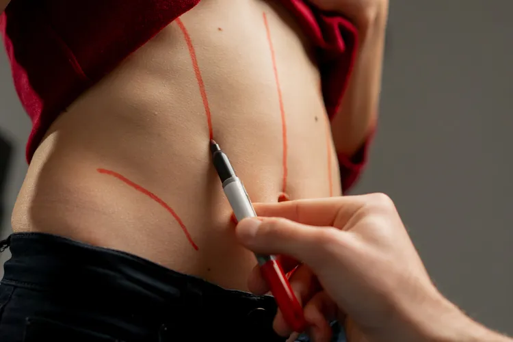 chirurgie esthétique, liposuccion sur l'abdomen