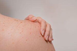des taches solaires sur l'épaule, causée par une exposition prolongée au soleil