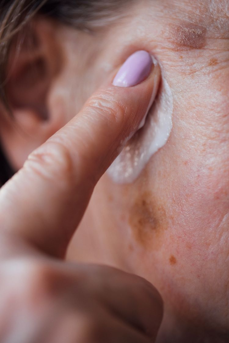 traitement naturel contre les taches de soleil