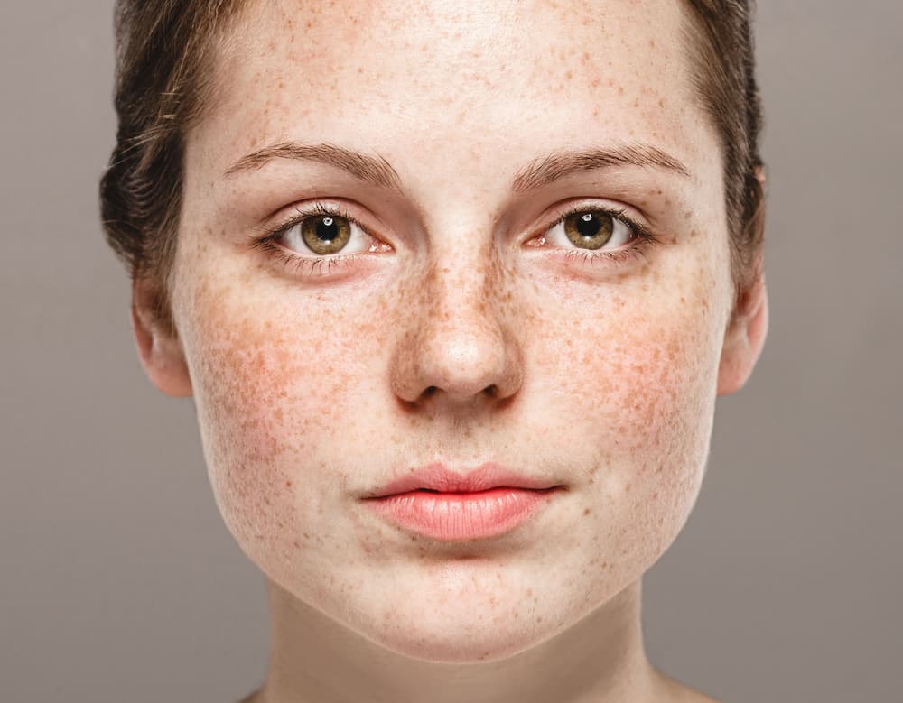 vitamine C ou niacinamide pour l’hyperpigmentation
